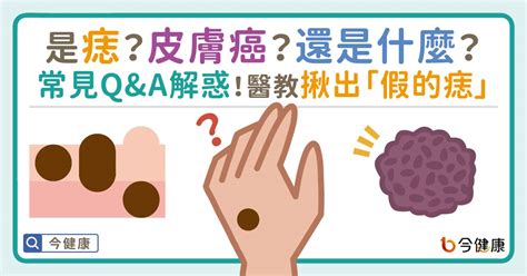 痣 顏色|是痣？還是皮膚癌？皮膚科醫師教你揪出「假的痣」，。